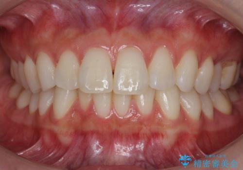 昔ワイヤー矯正をして後戻りした 軽度のがたつき モニター矯正の治療前