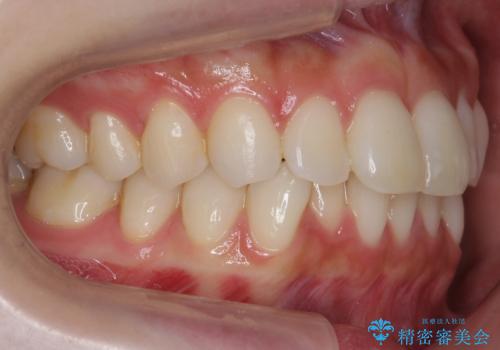 昔ワイヤー矯正をして後戻りした 軽度のがたつき モニター矯正の治療前