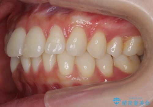 昔ワイヤー矯正をして後戻りした 軽度のがたつき モニター矯正の治療前