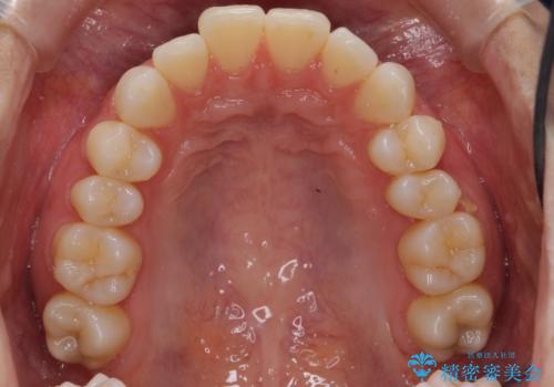 昔ワイヤー矯正をして後戻りした 軽度のがたつき モニター矯正の治療前