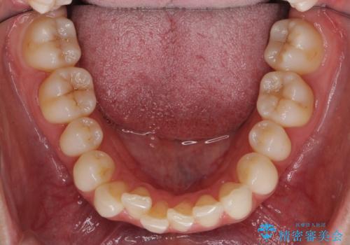 昔ワイヤー矯正をして後戻りした 軽度のがたつき モニター矯正の治療前