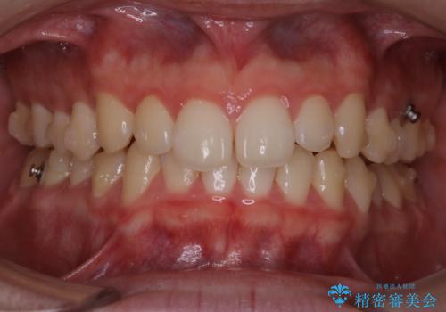 前歯が見えすぎる:インビザラインFULLで奥歯の噛み合わせも改善の治療中