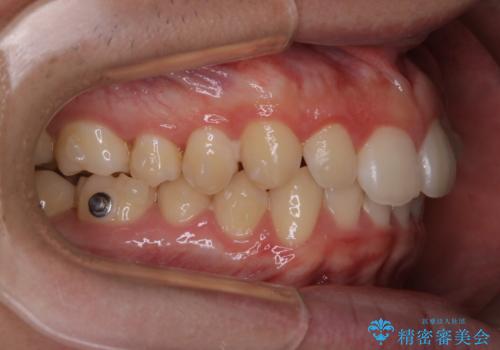 前歯が見えすぎる:インビザラインFULLで奥歯の噛み合わせも改善の治療中