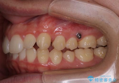 前歯が見えすぎる:インビザラインFULLで奥歯の噛み合わせも改善の治療中