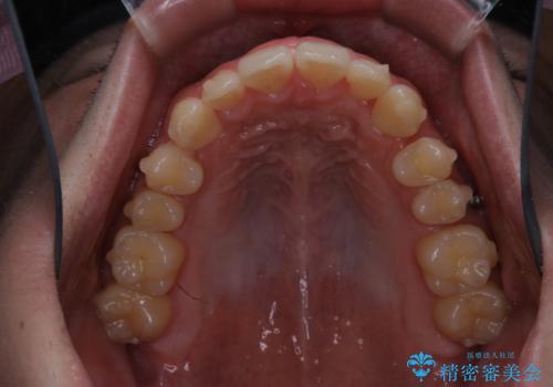 前歯が見えすぎる:インビザラインFULLで奥歯の噛み合わせも改善の治療中