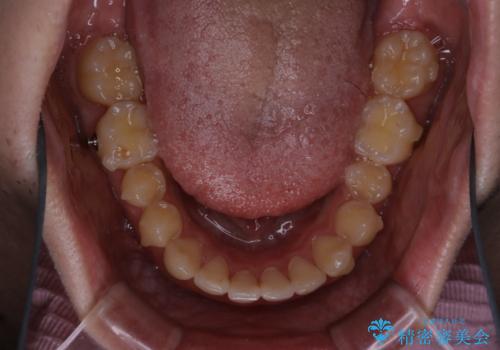 前歯が見えすぎる:インビザラインFULLで奥歯の噛み合わせも改善の治療中