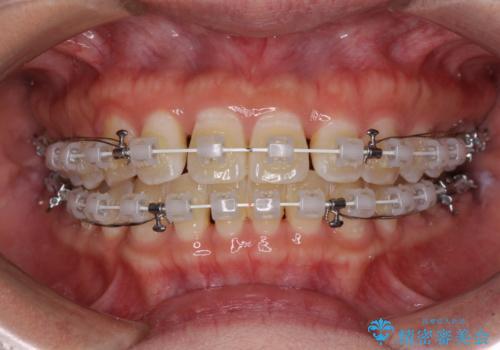 前歯の隙間と上下正中のズレを解消の治療中