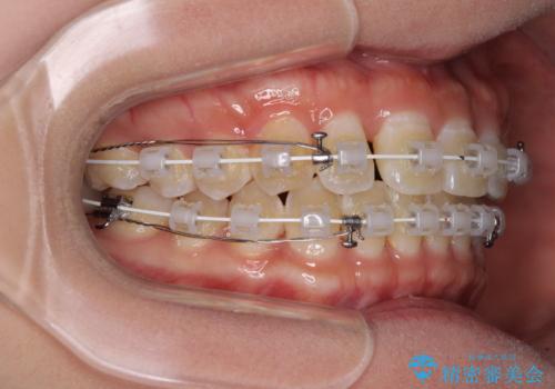 前歯の隙間と上下正中のズレを解消の治療中