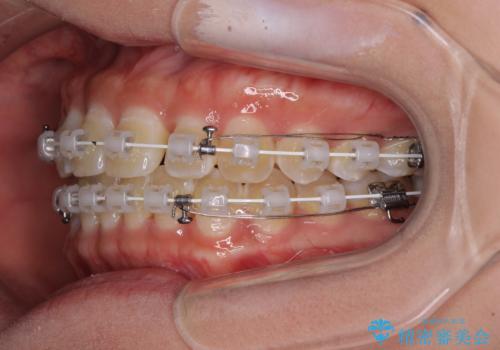 前歯の隙間と上下正中のズレを解消の治療中