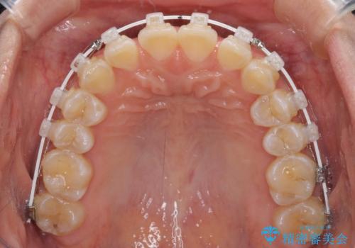 前歯の隙間と上下正中のズレを解消の治療中