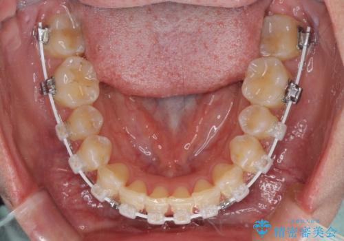 前歯の隙間と上下正中のズレを解消の治療中