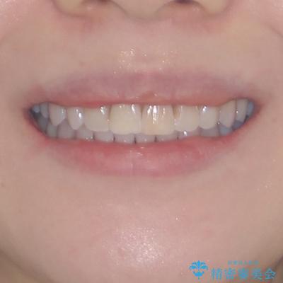 前歯の突出感とデコボコをインビザライン矯正で改善の治療後（顔貌）
