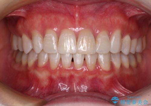 前歯の突出感とデコボコをインビザライン矯正で改善の症例 治療後