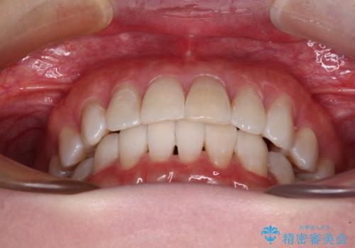 前歯の突出感とデコボコをインビザライン矯正で改善の治療後