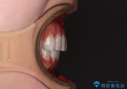 前歯の突出感とデコボコをインビザライン矯正で改善の治療後