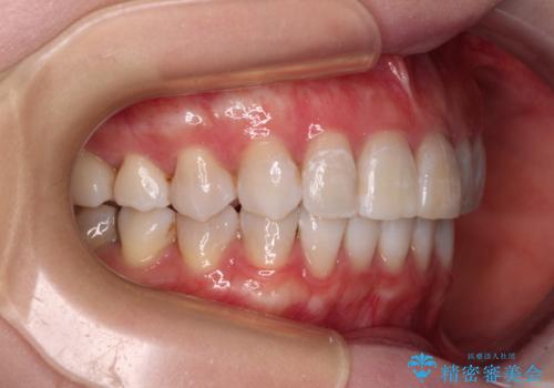 前歯の突出感とデコボコをインビザライン矯正で改善の治療後