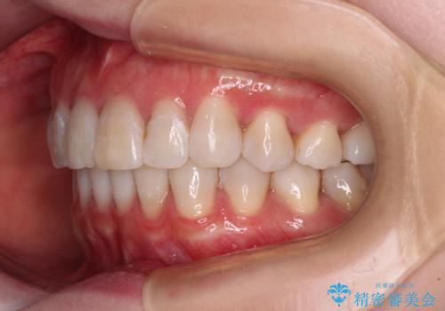 前歯の突出感とデコボコをインビザライン矯正で改善の治療後