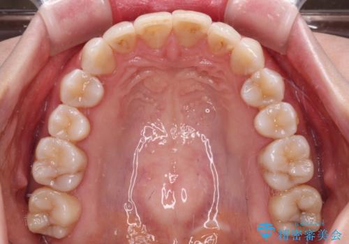 前歯の突出感とデコボコをインビザライン矯正で改善の治療後
