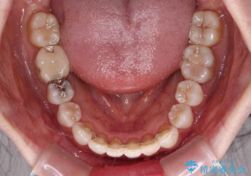 前歯の突出感とデコボコをインビザライン矯正で改善の治療後