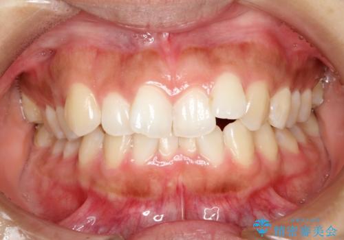 飛び出した前歯が気になる! 前歯のガタガタを抜歯をせずに治した症例の症例 治療前