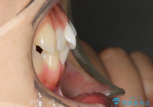 飛び出した前歯が気になる! 前歯のガタガタを抜歯をせずに治した症例の治療前
