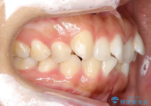 飛び出した前歯が気になる! 前歯のガタガタを抜歯をせずに治した症例の治療前