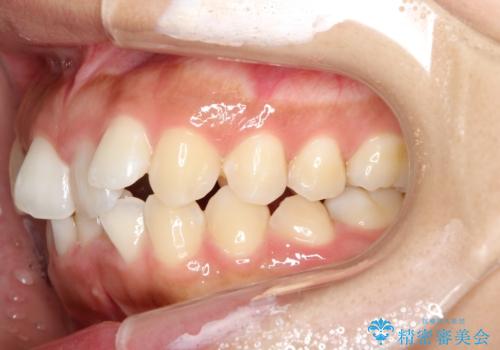 飛び出した前歯が気になる! 前歯のガタガタを抜歯をせずに治した症例の治療前