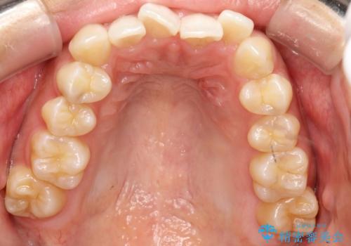 飛び出した前歯が気になる! 前歯のガタガタを抜歯をせずに治した症例の治療前