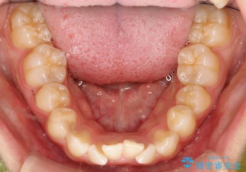 飛び出した前歯が気になる! 前歯のガタガタを抜歯をせずに治した症例の治療前