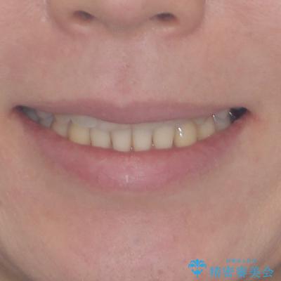 リスク回避 ワイヤー矯正を併用したインビザライン矯正治療の治療後(顔貌)