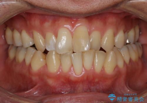 再矯正症例　前歯のガタガタと噛み合わせのズレをマウスピースで治した症例の治療前