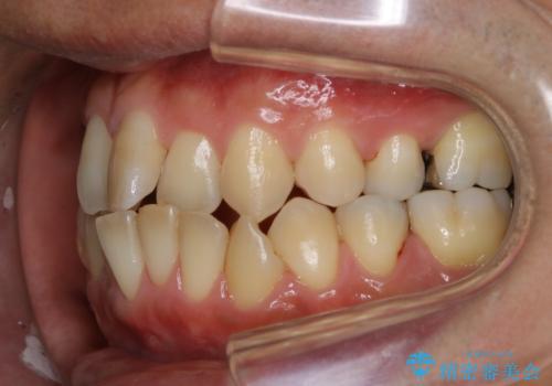 再矯正症例 前歯のガタガタと噛み合わせのズレをマウスピースで治した症例の治療前