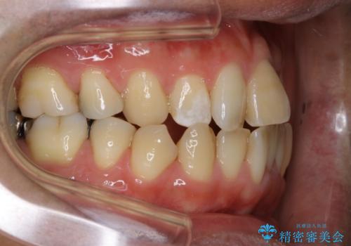 再矯正症例 前歯のガタガタと噛み合わせのズレをマウスピースで治した症例の治療前