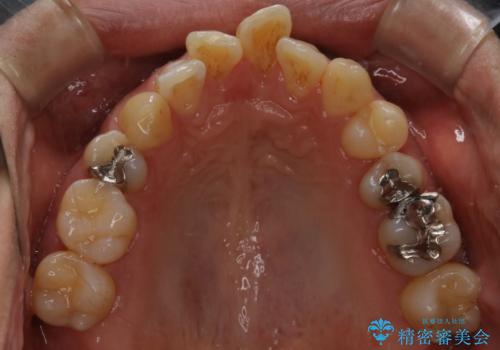 再矯正症例　前歯のガタガタと噛み合わせのズレをマウスピースで治した症例の治療前