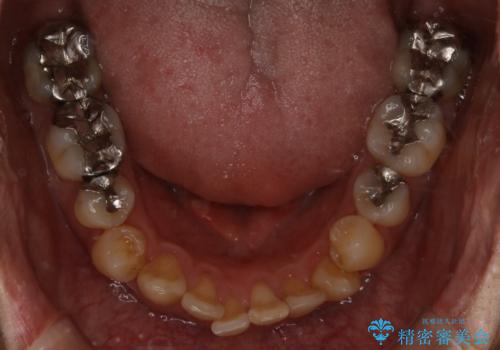 再矯正症例 前歯のガタガタと噛み合わせのズレをマウスピースで治した症例の治療前