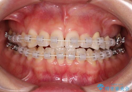 捻れた前歯と銀歯のブリッジを治したい ワイヤー矯正とオールセラミックブリッジの治療中