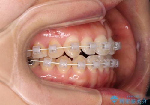 捻れた前歯と銀歯のブリッジを治したい ワイヤー矯正とオールセラミックブリッジの治療中
