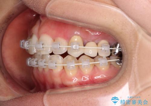 捻れた前歯と銀歯のブリッジを治したい ワイヤー矯正とオールセラミックブリッジの治療中