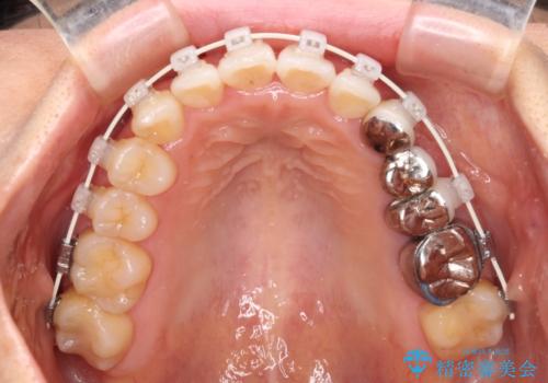 捻れた前歯と銀歯のブリッジを治したい ワイヤー矯正とオールセラミックブリッジの治療中