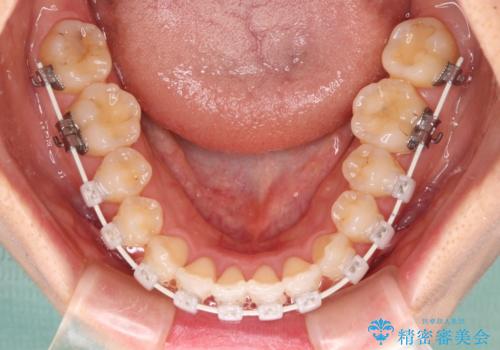 捻れた前歯と銀歯のブリッジを治したい ワイヤー矯正とオールセラミックブリッジの治療中