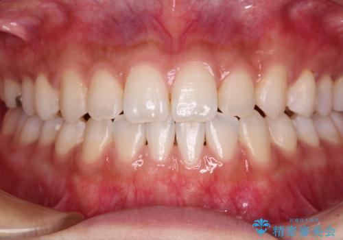 舌突出癖で口元が開いてしまう 舌トレーニングを行ったインビザライン矯正の症例 治療後