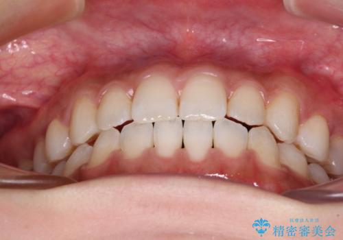 舌突出癖で口元が開いてしまう 舌トレーニングを行ったインビザライン矯正の治療後