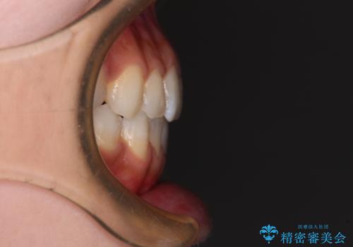 舌突出癖で口元が開いてしまう 舌トレーニングを行ったインビザライン矯正の治療後