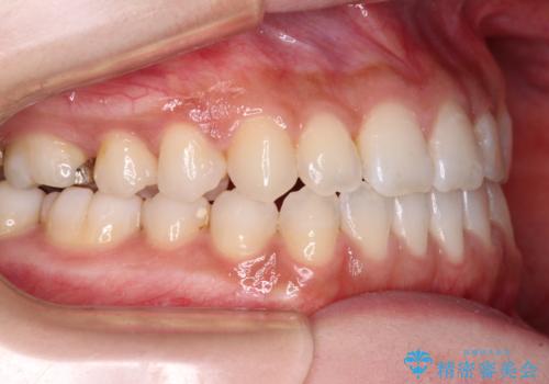 舌突出癖で口元が開いてしまう 舌トレーニングを行ったインビザライン矯正の治療後