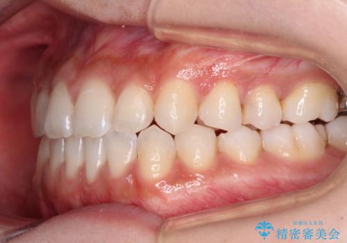 舌突出癖で口元が開いてしまう 舌トレーニングを行ったインビザライン矯正の治療後