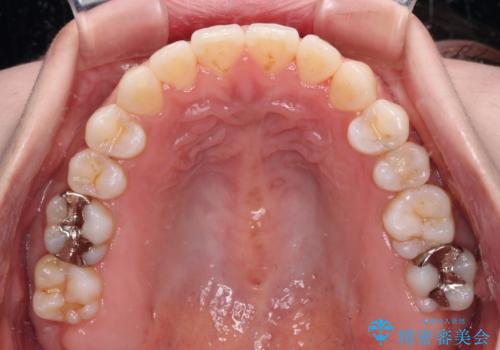 舌突出癖で口元が開いてしまう 舌トレーニングを行ったインビザライン矯正の治療後