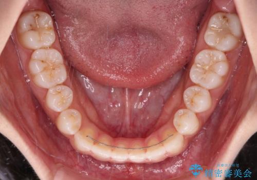 舌突出癖で口元が開いてしまう　舌トレーニングを行ったインビザライン矯正の治療後