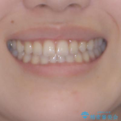 舌突出癖で口元が開いてしまう 舌トレーニングを行ったインビザライン矯正の治療後(顔貌)