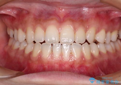 舌突出癖で口元が開いてしまう 舌トレーニングを行ったインビザライン矯正の治療中