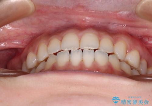 舌突出癖で口元が開いてしまう 舌トレーニングを行ったインビザライン矯正の治療中
